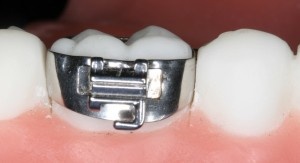 ortodontic_band