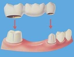 Bridge-Dentists