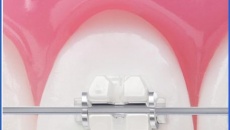 Особливості вирівнювання та випрямляння зубів з допомогою брекетів у дорослих.