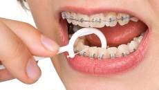 Чищення зубів ниткою при носінні брекетів: омани
