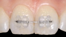 Установка брекетів на кілька зубів