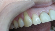 Що робити якщо зуби видно через ясна? Причини. Наслідки. Рішення