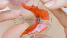 Як часто підкручувати ортодонтичну пластину?