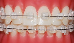 clear-braces-ortho-technology-pure