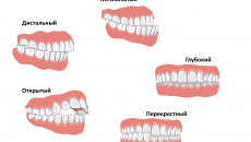 Побічний дефект: до чого призводить неправильний прикус