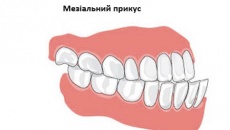 Мезіальний прикус