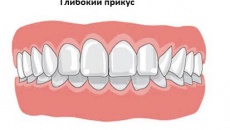 Виправлення глибокого прикусу