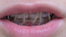 Еластичні кільця на фронтальні зуби!